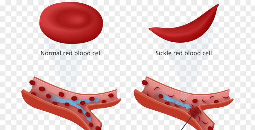 World Health Day Sickle Cell Disease Anemia Trait Red Blood PNG