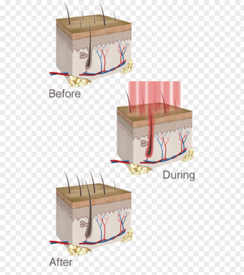 Laser Low-level Therapy Management Of Hair Loss PNG