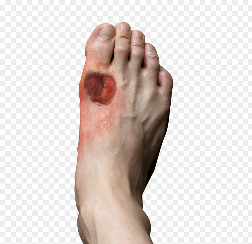 Wounds Diabetic Foot Ulcer Diabetes Mellitus Athlete's PNG