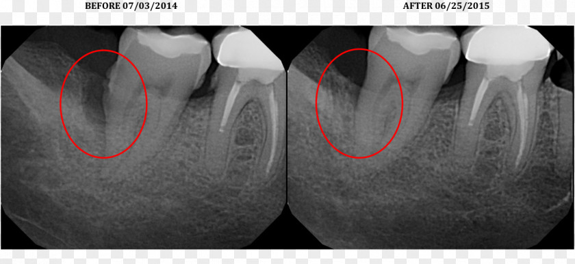 Gum Disease Laser-assisted New Attachment Procedure Surgery Periodontology X-ray PNG