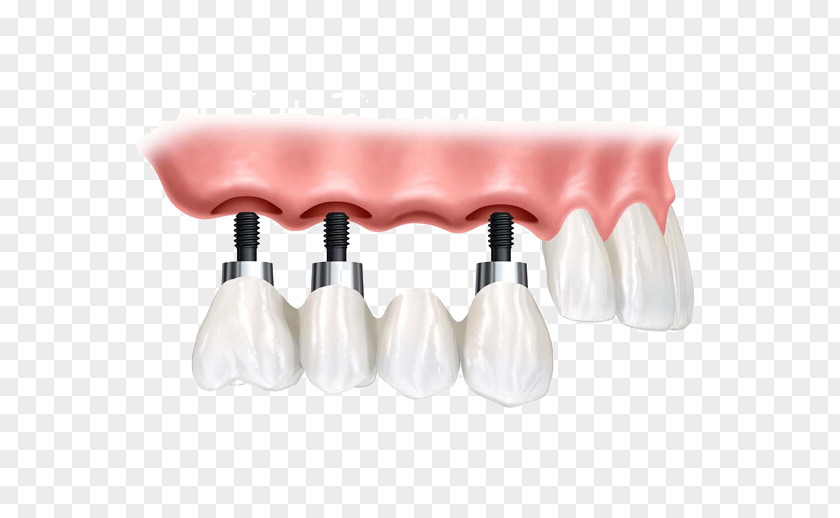 Planting Teeth Picture Dental Implant Dentistry Bridge PNG