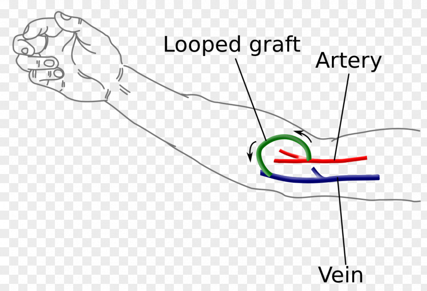 Blood Arteriovenous Fistula Hemodialysis Vascular Access Surgery PNG