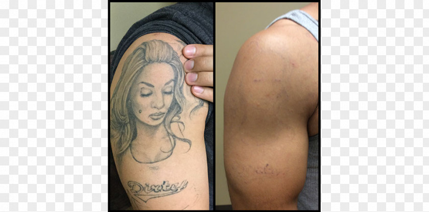 Absolute Laser Tattoo Removal Artist Abziehtattoo PNG