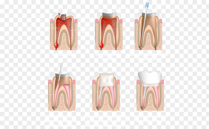 Root Canal Endodontic Therapy Endodontics Dentistry PNG