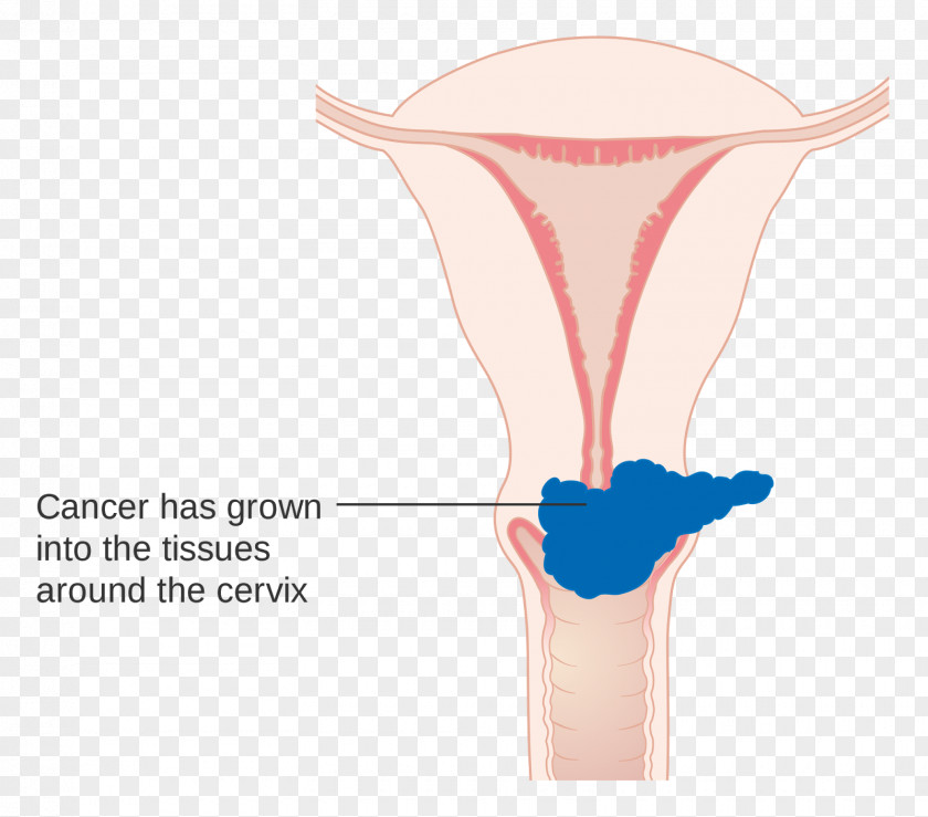 Cervical Cancer Staging Cervix PNG