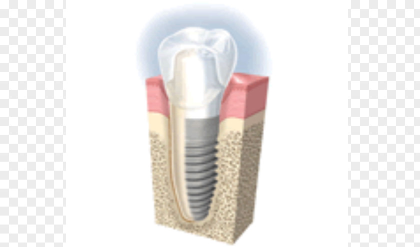 Crown Dental Implant Cosmetic Dentistry Tooth Loss PNG