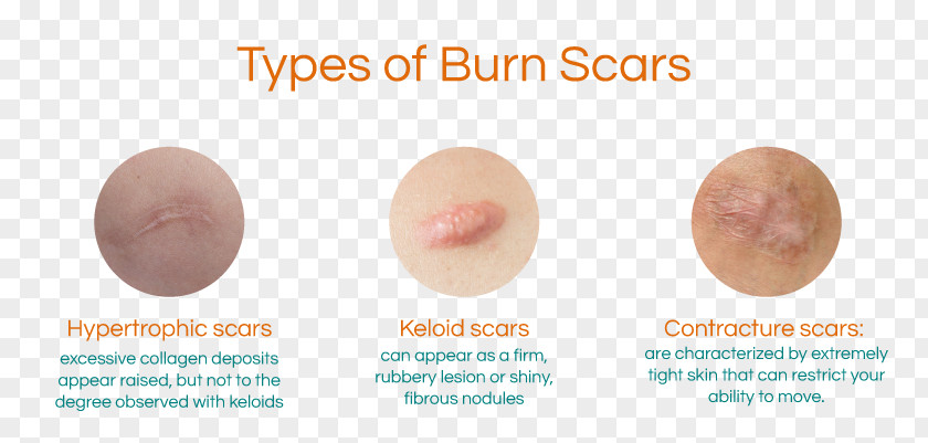Burn Scar Contracture Hypertrophic Keloid PNG