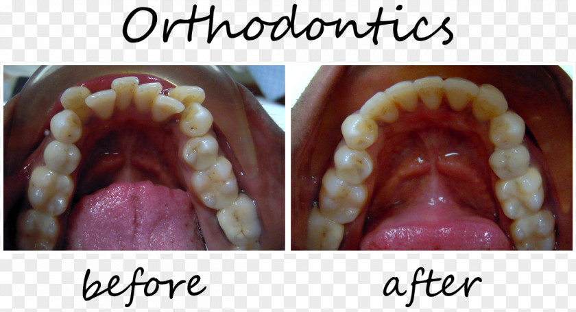 Orthodontics Dentistry Veneer Smiles Of Cary The Lumineers PNG