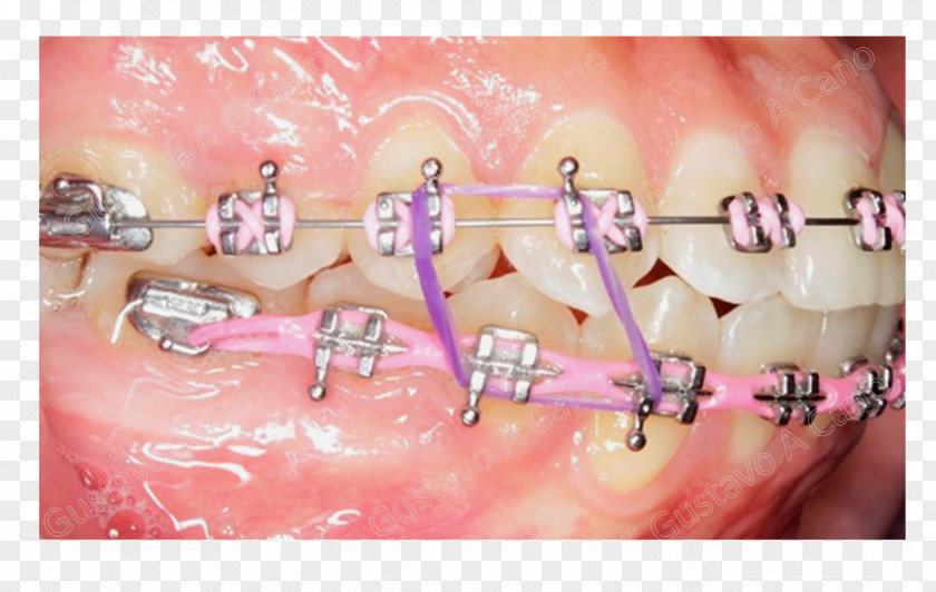 Orthodontic Orthodontics Dentistry Dental Braces Tooth Elasticity PNG