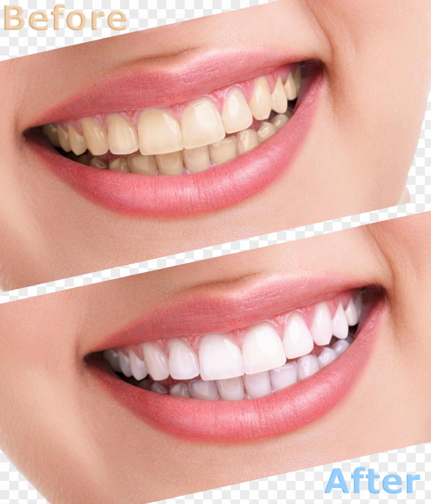 Comparison Of Cleaning Teeth Tooth Whitening Human Cosmetic Dentistry PNG
