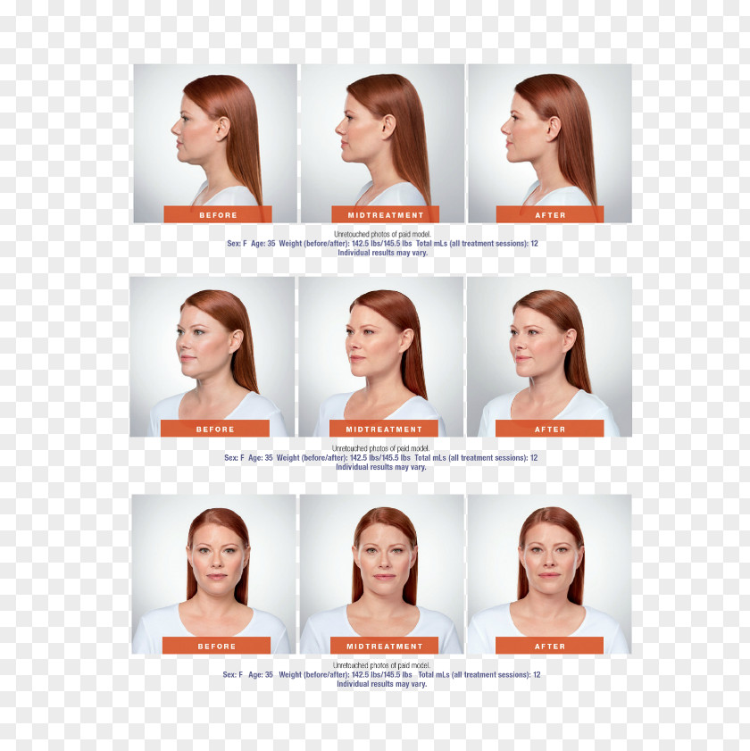 Face Deoxycholic Acid Surgery Chin Submental Triangle PNG