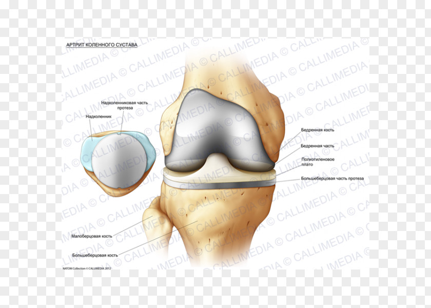 Knee Osteoarthritis Rheumatology Synovial Fluid Prosthesis PNG