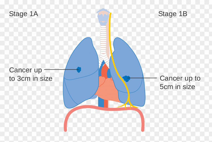 Lung Cancer Staging PNG