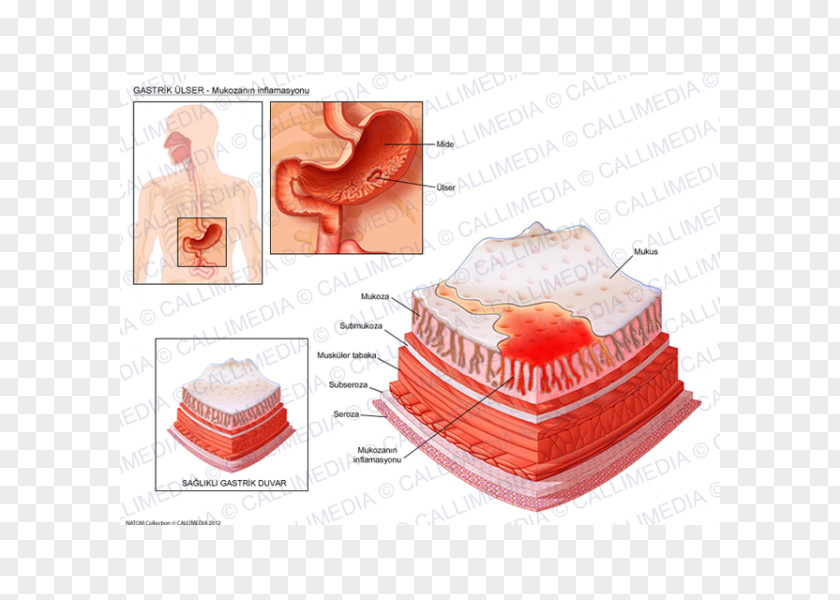 Ulcer Peptic Disease Skin Erosion Inflammation Gastritis PNG
