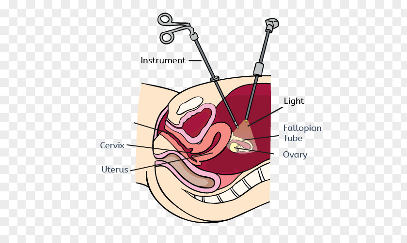 Infertility Uterine Fibroid Laparoscopy Myomectomy Endometriosis Laparotomy PNG