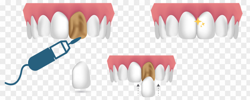 Dental Hospital Cosmetic Dentistry Veneer Composite Human Tooth PNG