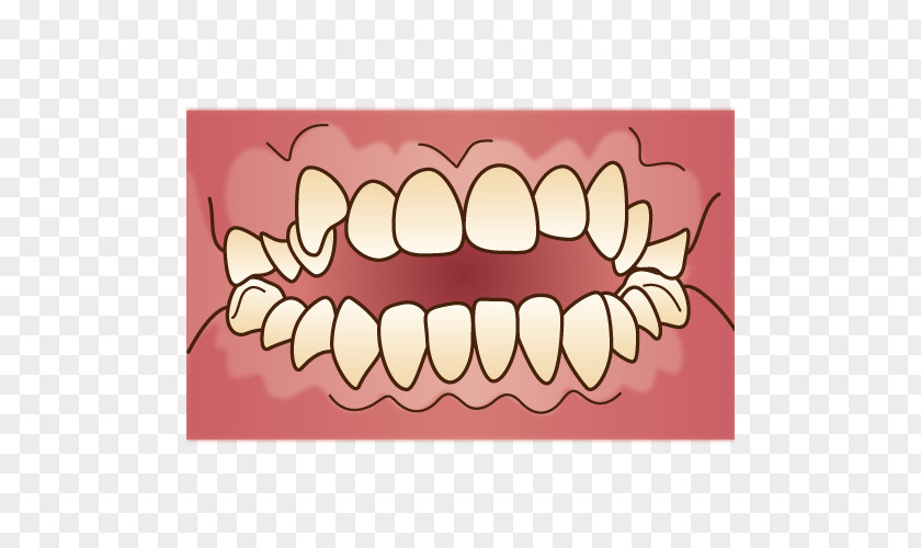 Dental Braces 矯正歯科 Dentist Therapy Dentition PNG