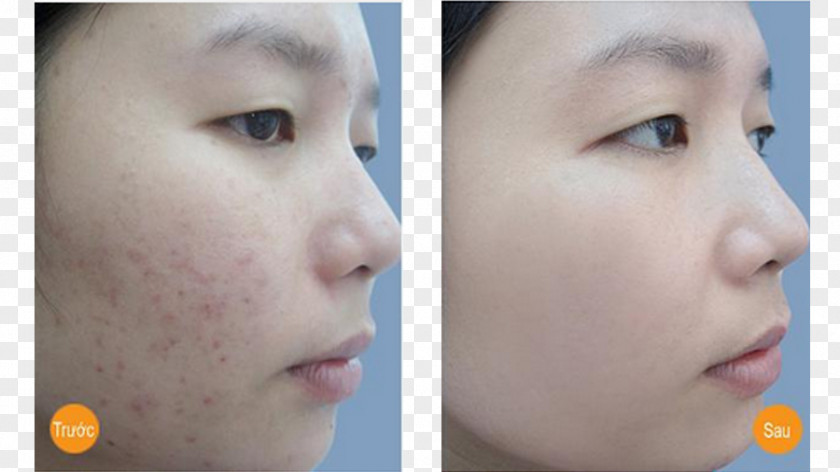 Scar Mụn Acne Therapy Hemorrhoid PNG