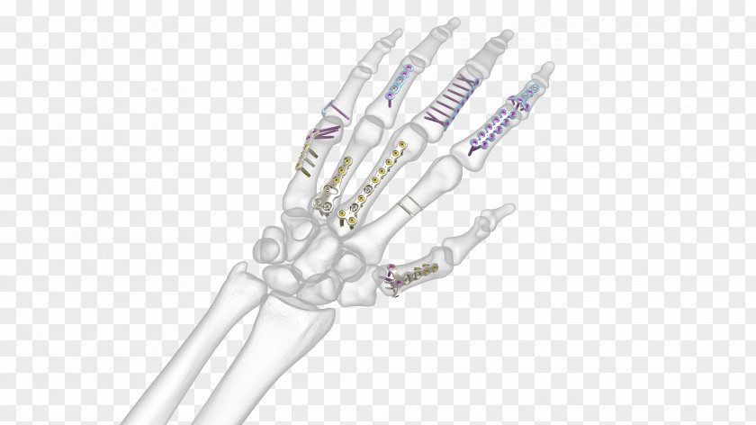 Bones Hand Bone Fracture Synthes Metacarpal Anatomy PNG