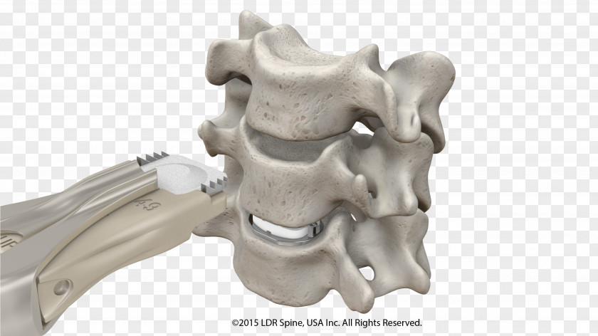 Spine Intervertebral Disc Arthroplasty Anterior Cervical Discectomy And Fusion Spinal Implant PNG