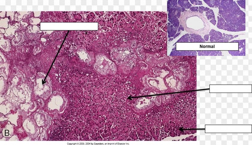 Microscope Acute Pancreatitis Histopathology Histology Necrosis Disease PNG