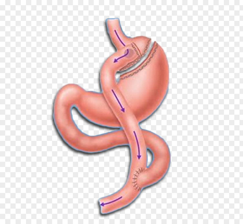 Gastric Bypass Surgery Roux-en-Y Anastomosis Bariatric Sleeve Gastrectomy PNG