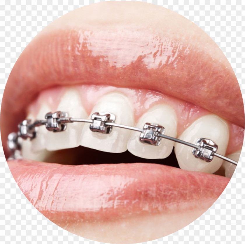 Dental Care Orthodontics Braces Dentistry Damon System PNG