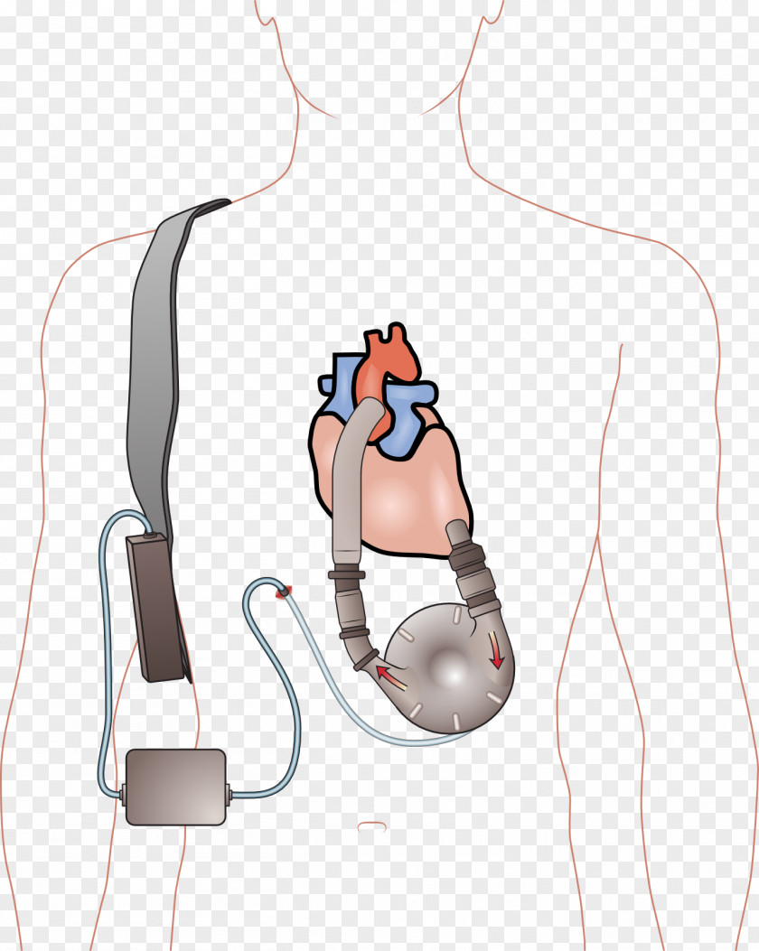 Blood Flow Ventricular Assist Device Artificial Heart Ventricle Failure PNG