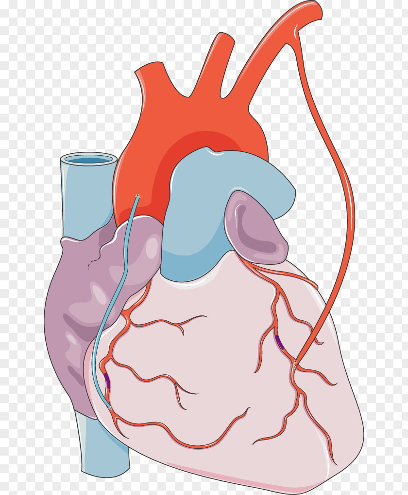 The Anatomy Of A Body Medicine Myocardial Infarction Heart Coronary Artery Disease Blood PNG