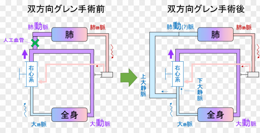 Fukuoka Municipal Children Hospital Hypoplastic Left Heart Syndrome Disease Therapy PNG