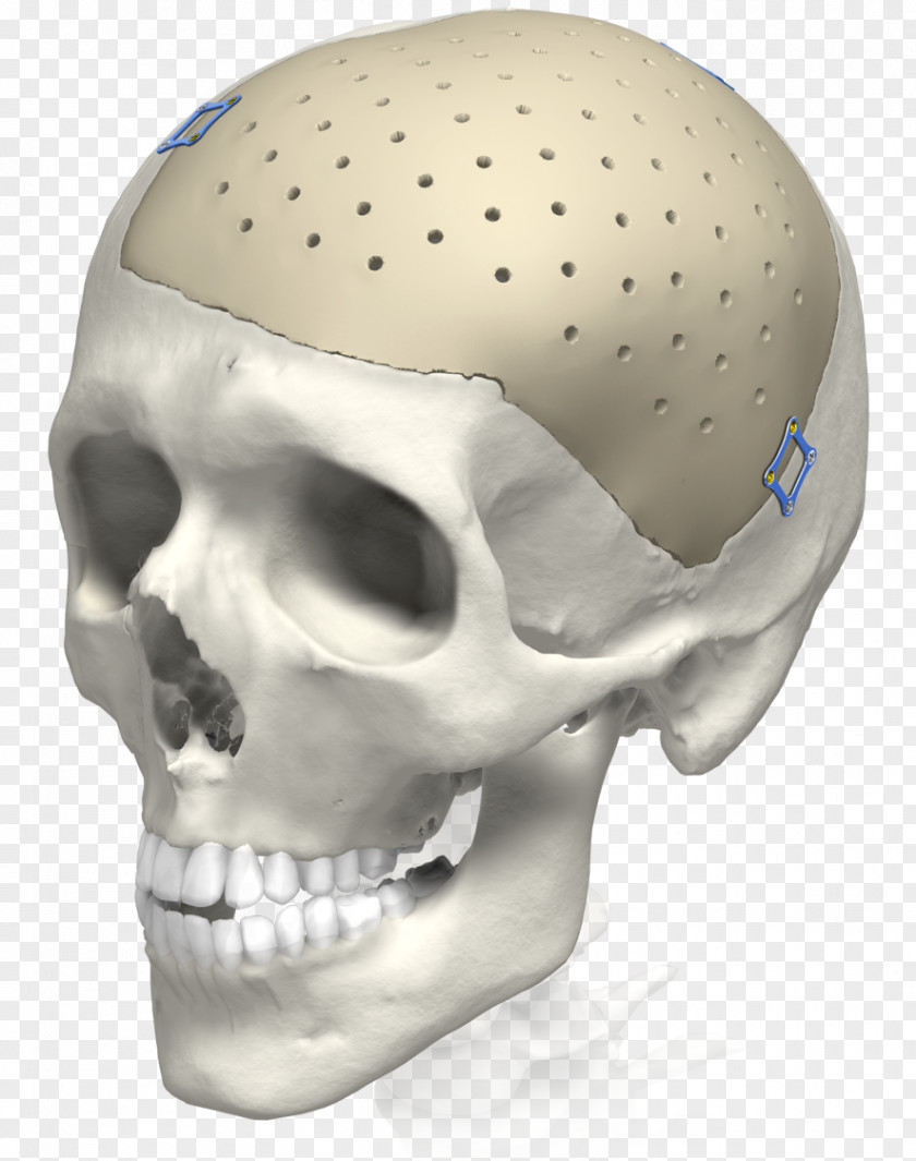 Skull Implant 3D Printing Karl Leibinger Medizintechnik GmbH & Co. KG Surgery PNG