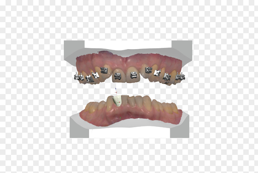 Design Tooth Dentures Prosthesis Computer-aided Computer Software PNG
