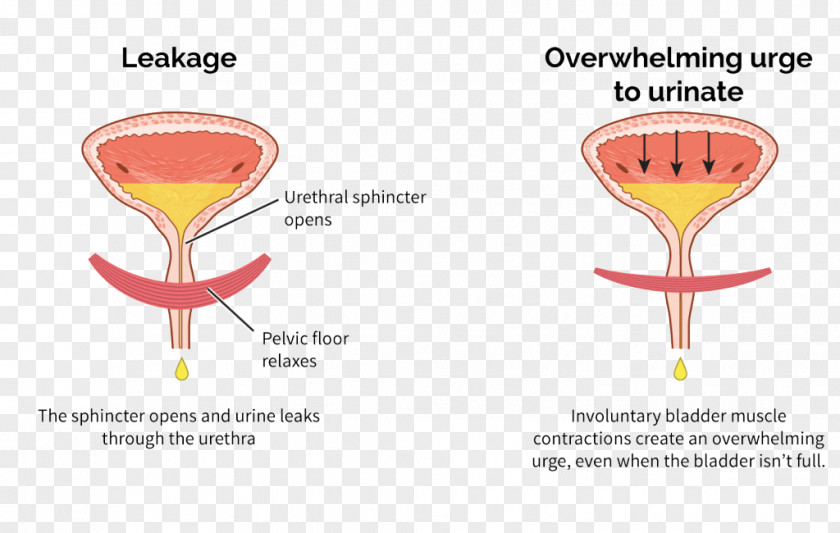 Overactive Bladder Urinary Incontinence Urethral Sphincters PNG