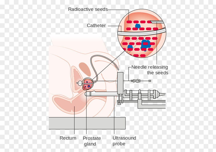 Radiation Therapy Prostate Cancer Brachytherapy Proton PNG