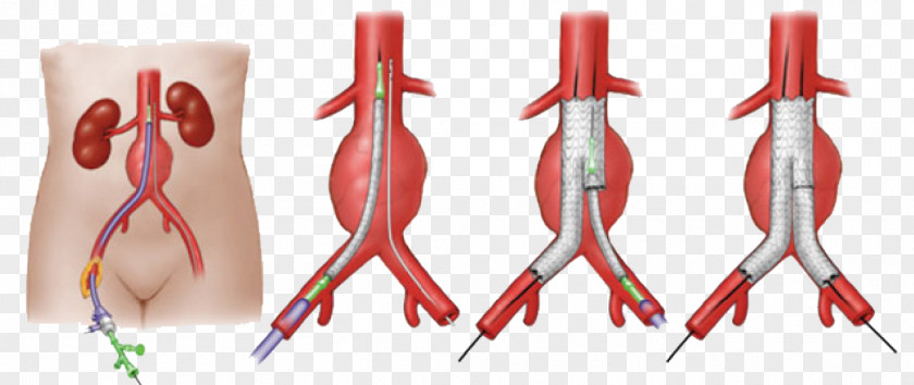 Heart Abdominal Aortic Aneurysm Endovascular Repair Vascular Surgery PNG