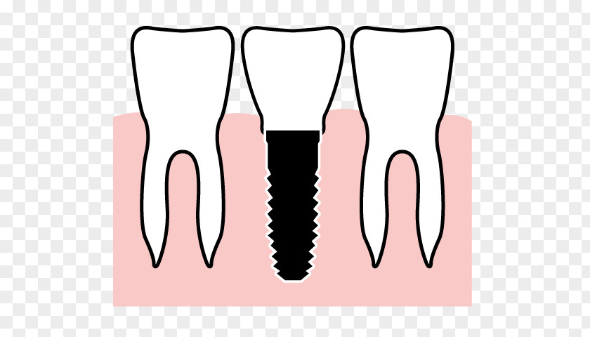 Health Tooth Gums Therapy Dental Implant PNG