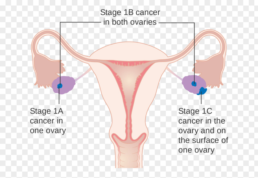 Ovarian Cancer Staging Ovary Research UK PNG