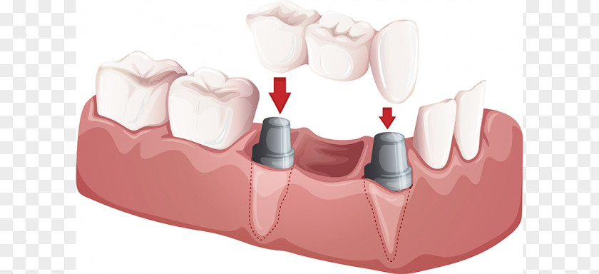 Bridge Dentistry Crown Dental Implant PNG