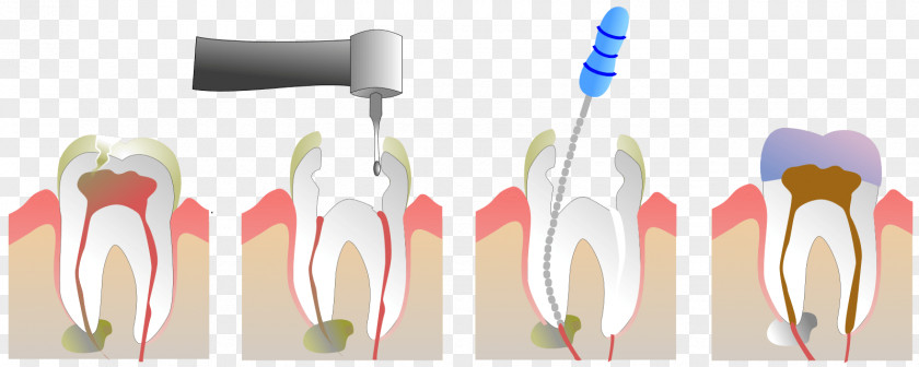 Tooth Endodontic Therapy Pulp Root Canal Dentistry PNG