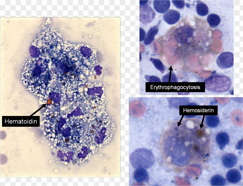 Low Powder University Of Liverpool Lesion StudyBlue Keratoacanthoma PNG