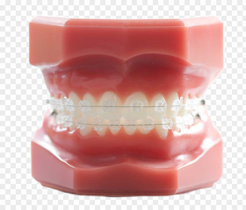 Dental Model Tooth Orthodontics Dentistry Braces PNG