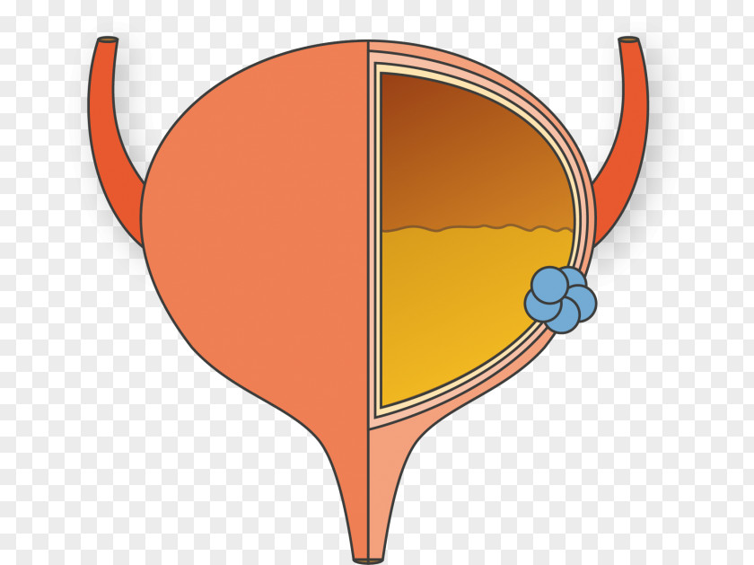 Organ Bladder Cancer Urinary Immunotherapy PNG cancer bladder Immunotherapy, clipart PNG