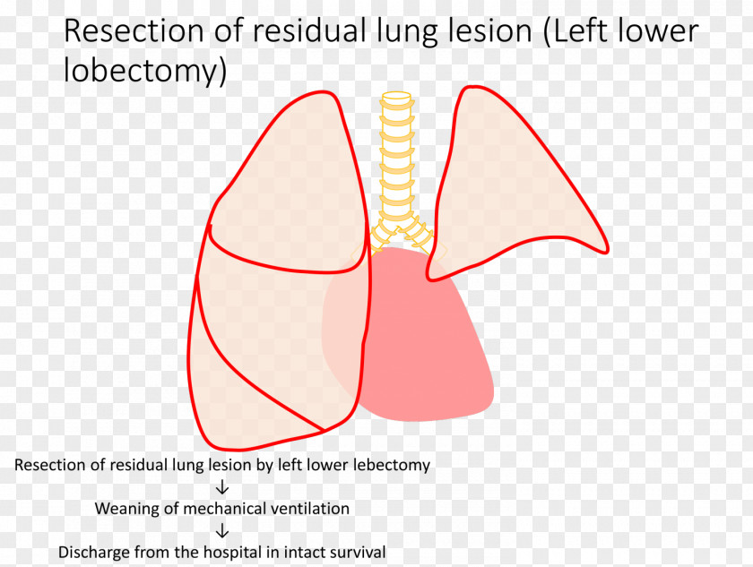 Aventura Pulmonary Institute Congenital Airway Malformation Lobectomy Segmental Resection Surgery Lung PNG