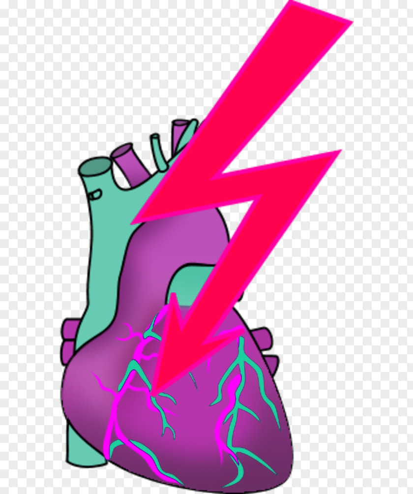 Heart Attack Myocardial Infarction Clip Art PNG