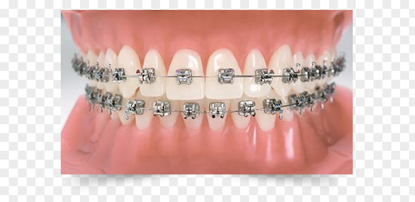 Dental Braces Orthodontics Dentistry Tooth PNG