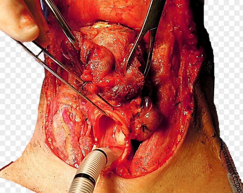 Trachea Laryngectomy Stoma Tracheotomy Glottis PNG