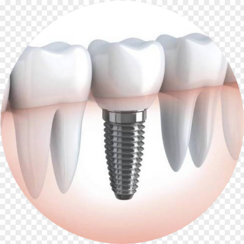 Crown Dental Implant Dentistry Dentures PNG