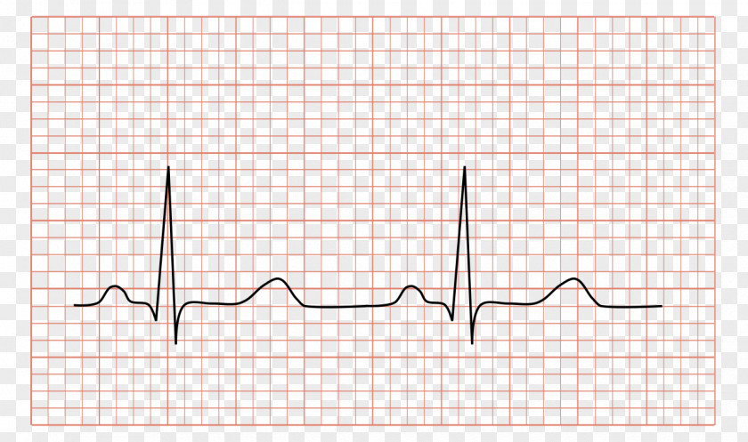 Strips Electrocardiography Heart QRS Complex Sinus Rhythm Sinoatrial Node PNG