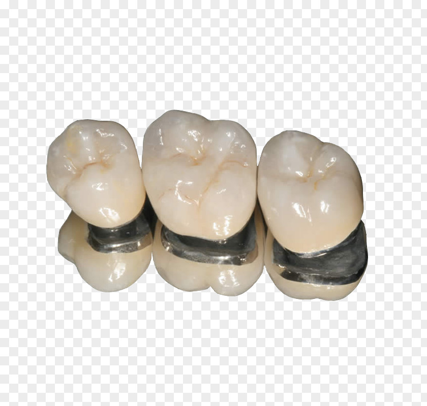 Crown Dentistry Bridge Ceramic PNG
