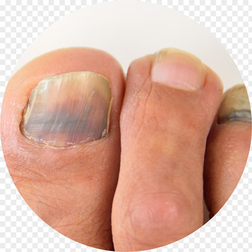 Fungi Nail Toe Foot Subungual Hematoma Hand PNG